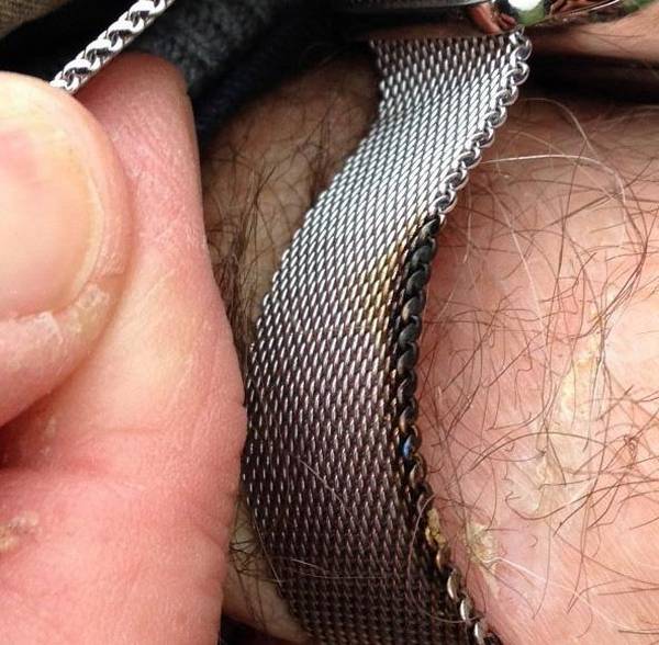 Apple Watch veroorzaakt brandwonden